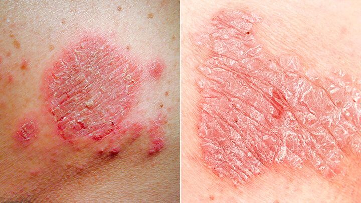 Difference Between Psoriasis And Eczema by dermatologist in Islamabad