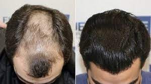 Best FUE Hair Transplant in Dubai