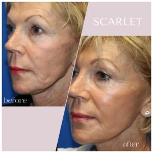 RF Microneedling: The Advanced Approach to Skin Tightening