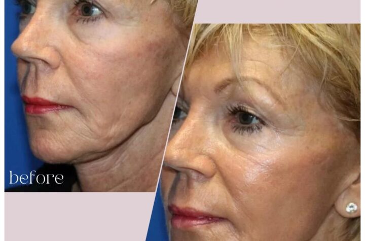 RF Microneedling: The Advanced Approach to Skin Tightening